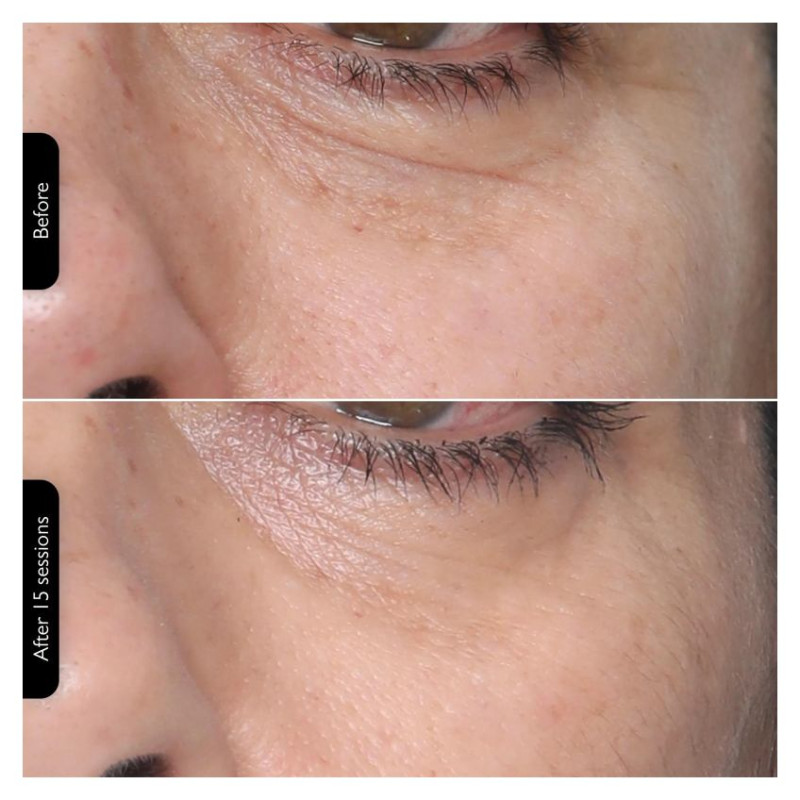 Silkn FTMP1PE1001 FaceTite MultiPlatform