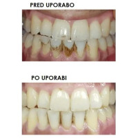 Silkn ToothWave TW1PE3001
