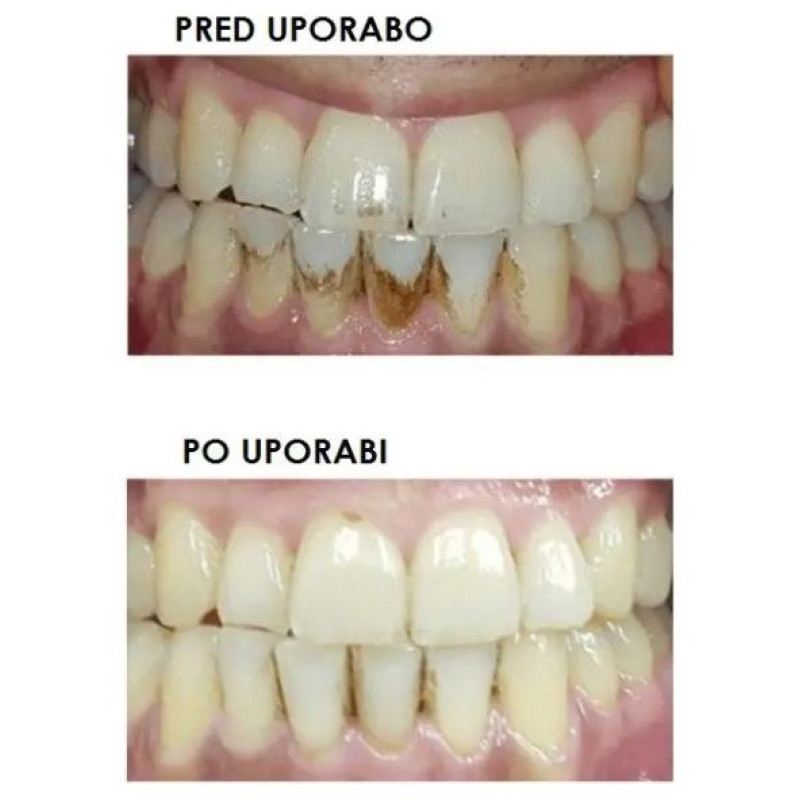 Silkn ToothWave TW1PE3001